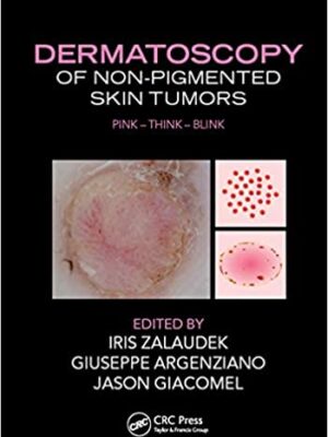 Dermatoscopy of Non-Pigmented Skin Tumors – eBook PDF